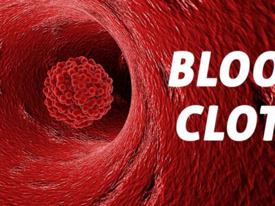 Blood Clot Symptoms