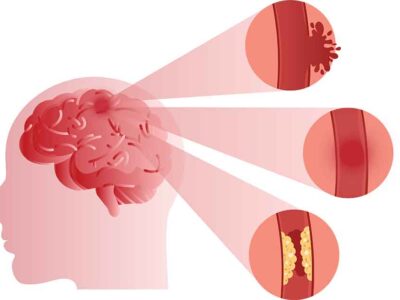 First Aid For Strokes