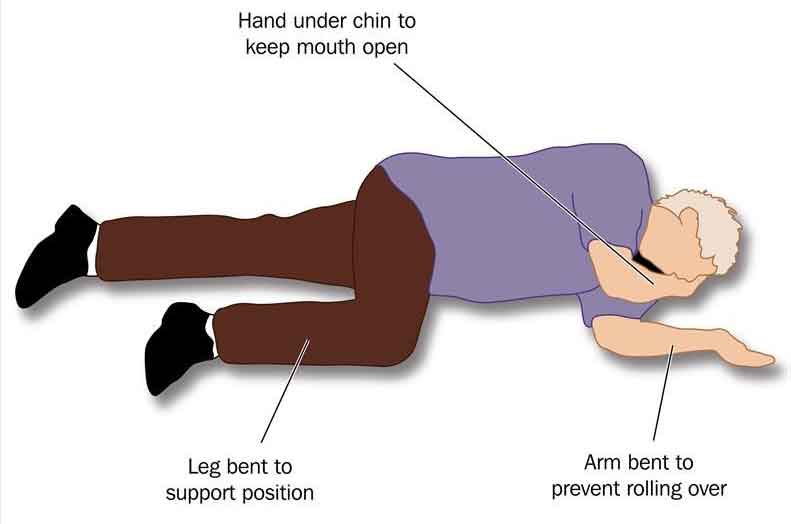 Recovery Position For Strokes