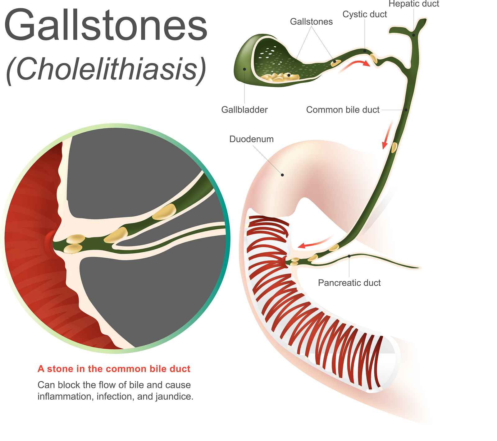 Symptoms of a Gallbladder Attack Elite Hospital Kingwood