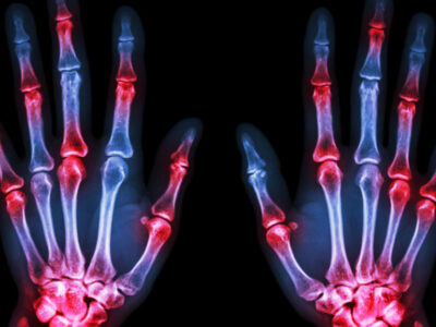 Arthritis Signs and Symptoms