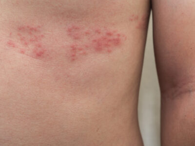 What is Shingles?