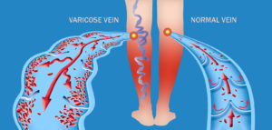 Varicose Veins vs. Spider Veins: What You Need To Know