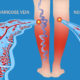 Varicose Veins vs. Spider Veins: What You Need To Know