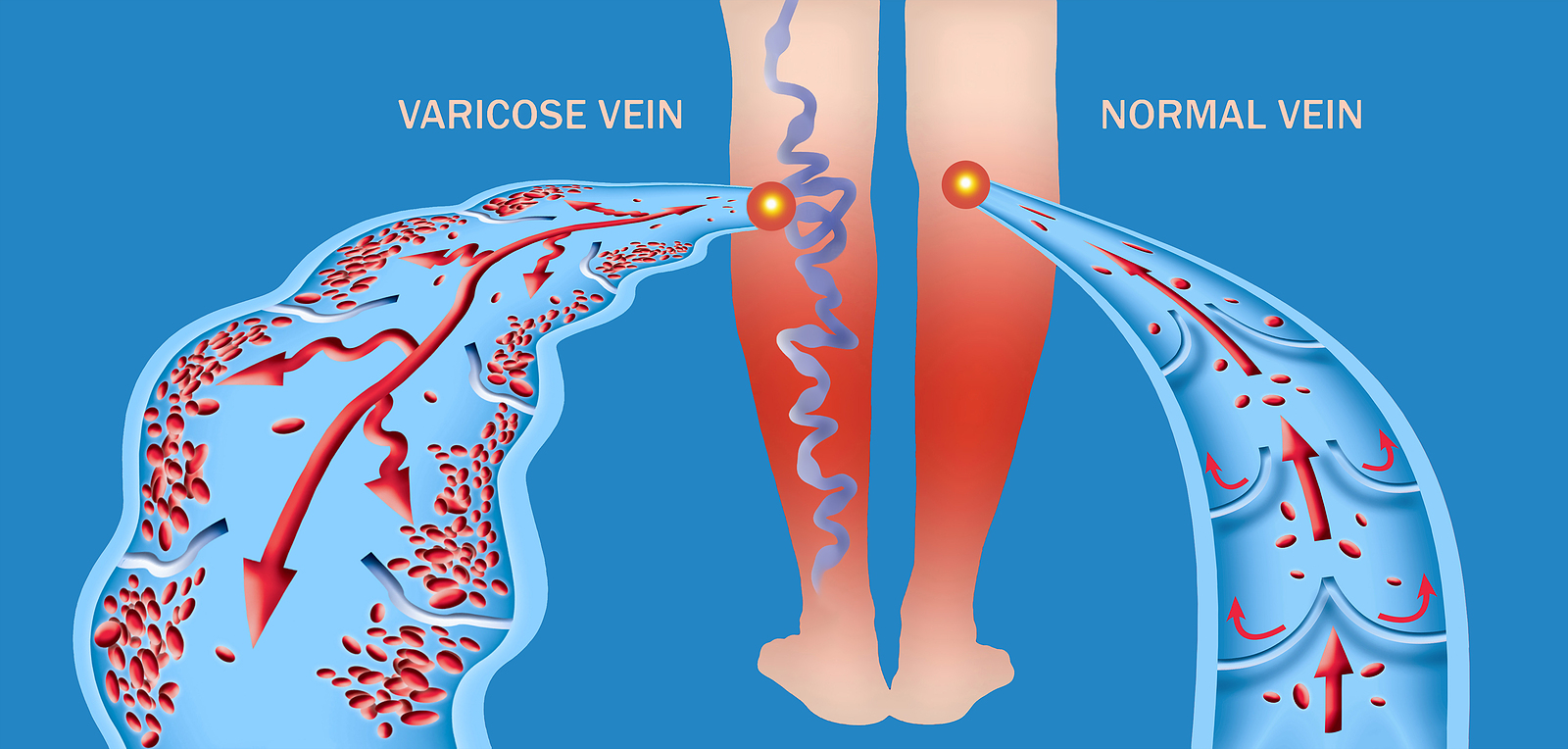 Get a leg up on varicose veins - Mayo Clinic Health System