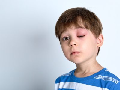 Eye Injuries – When to Go to the ER