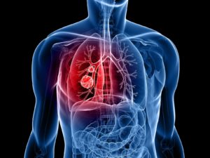 How To Know If You Have Lung Cancer - Signs and Symptoms
