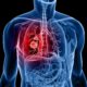 How To Know If You Have Lung Cancer - Signs and Symptoms