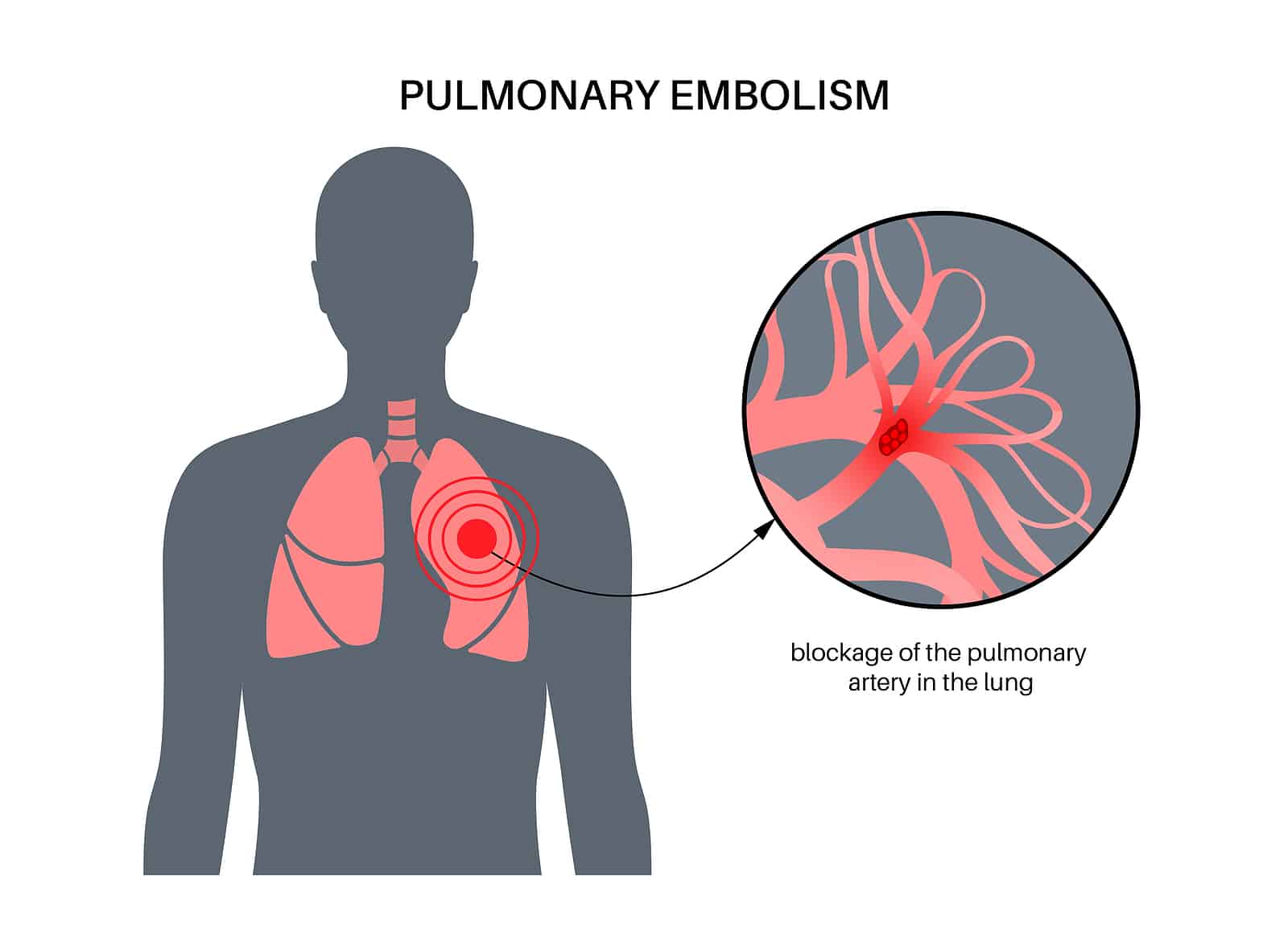 3 Symptoms Of Pulmonary Embolism Elite Hospital Kingwood